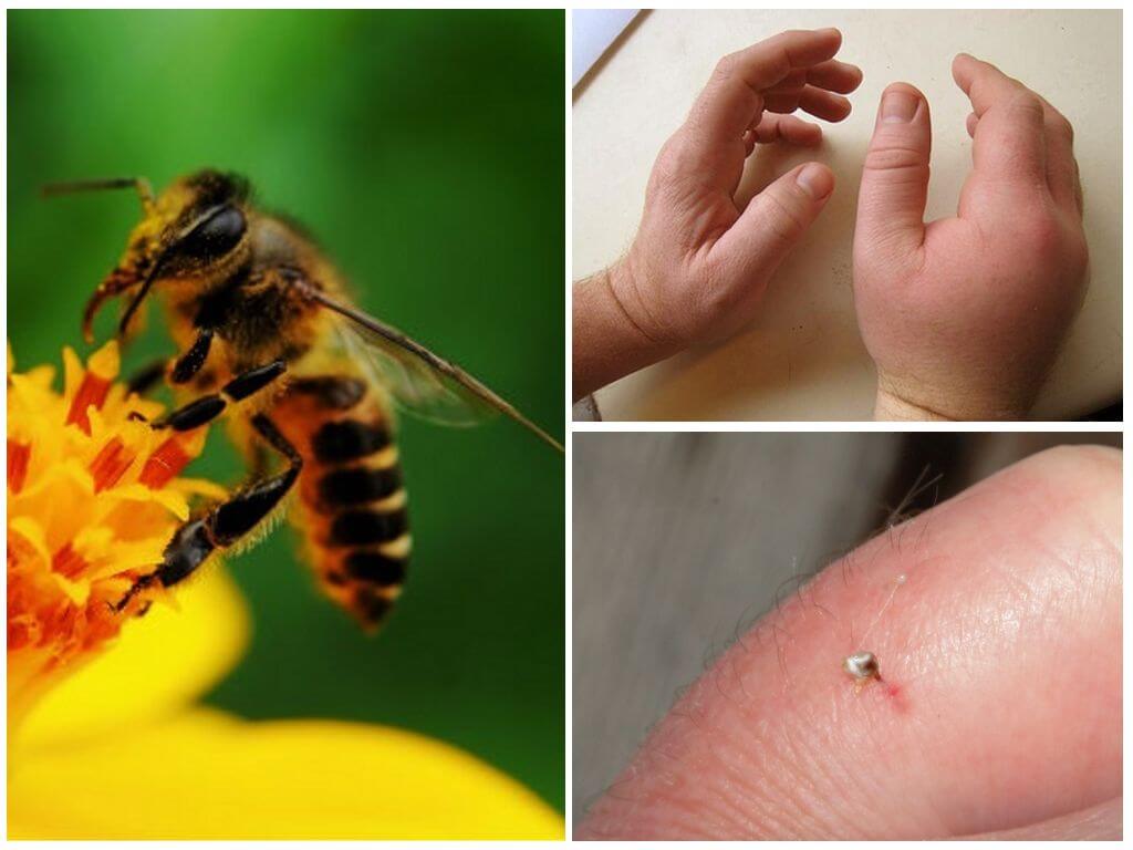 Аллергия на укусы насекомых: виды, симптомы, лечение, профилактика