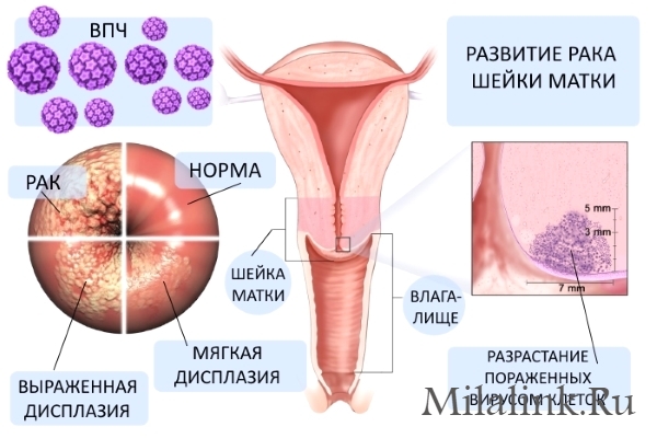 Всегда ли ВПЧ приводит к раку шейки матки