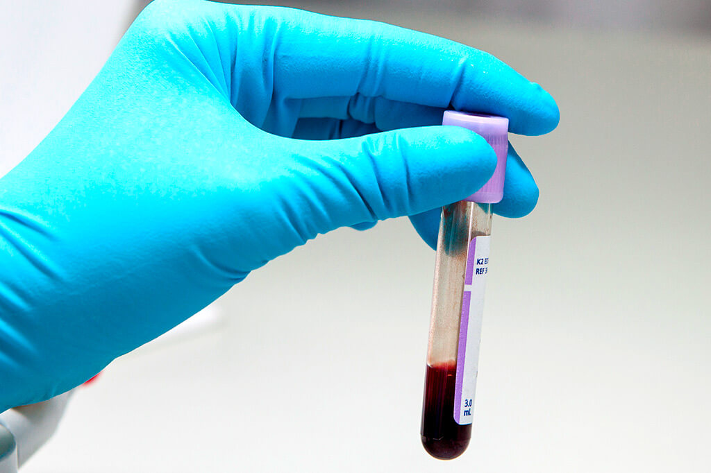 Анализ крови ТТГ: показания, норма, результаты