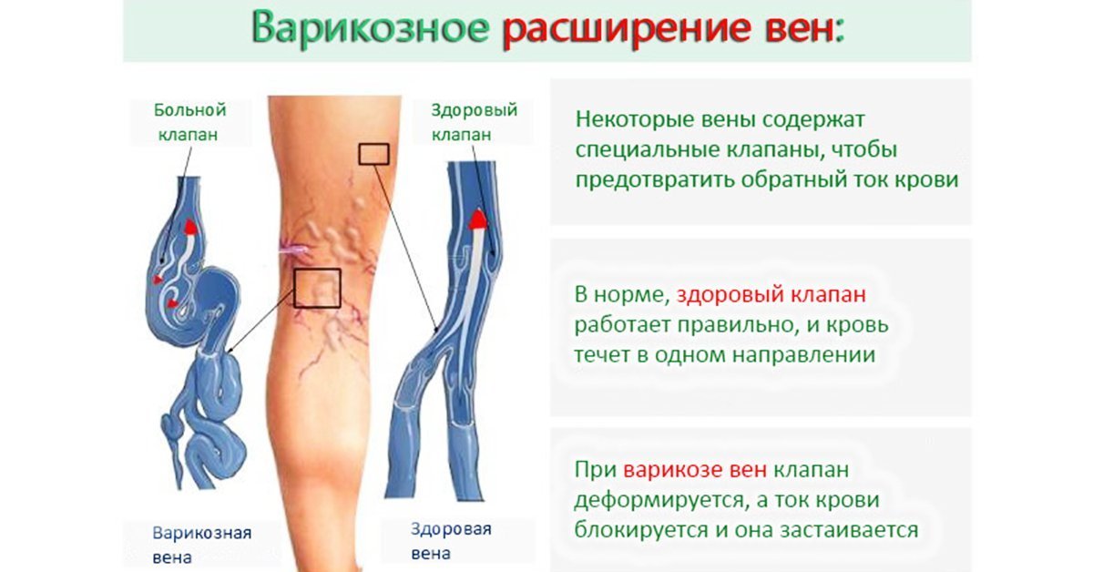 Почему нужно лечить варикозное расширение вен