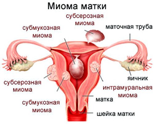 Что такое миома матки и как ее лечить