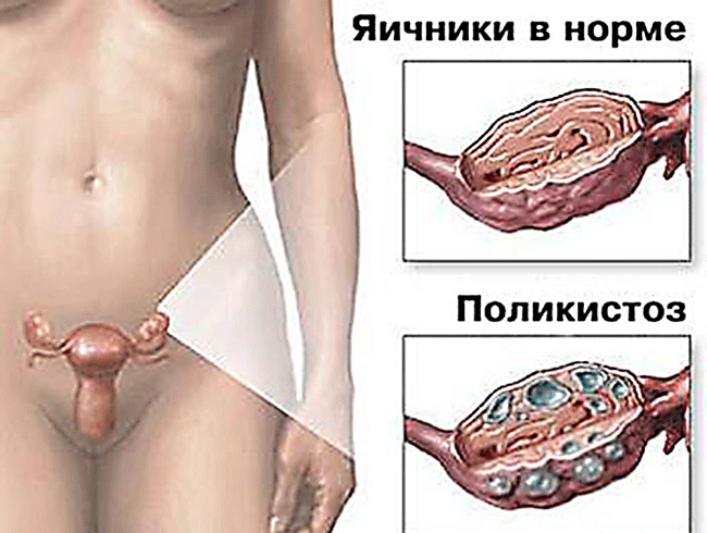 Синдром поликистозных яичников