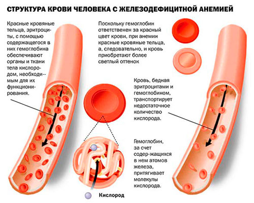 анемия. Как определить и что делать