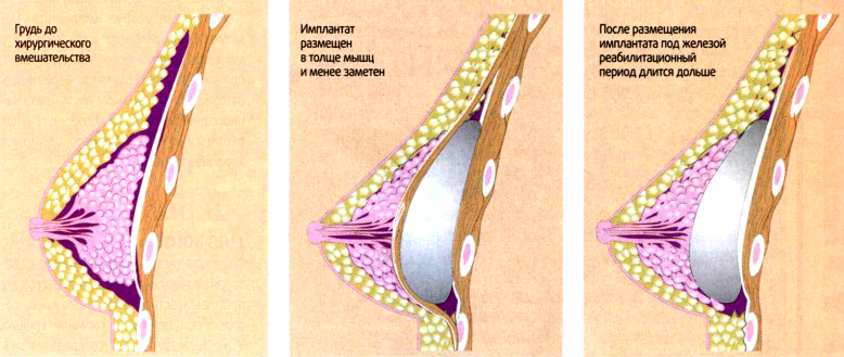 Как проходит операция по увеличению груди