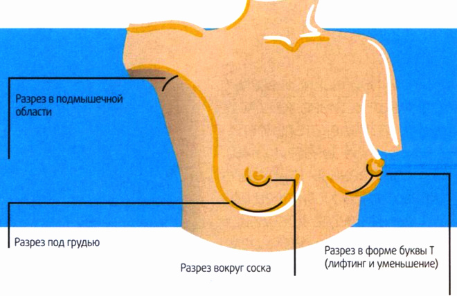 увеличение груди