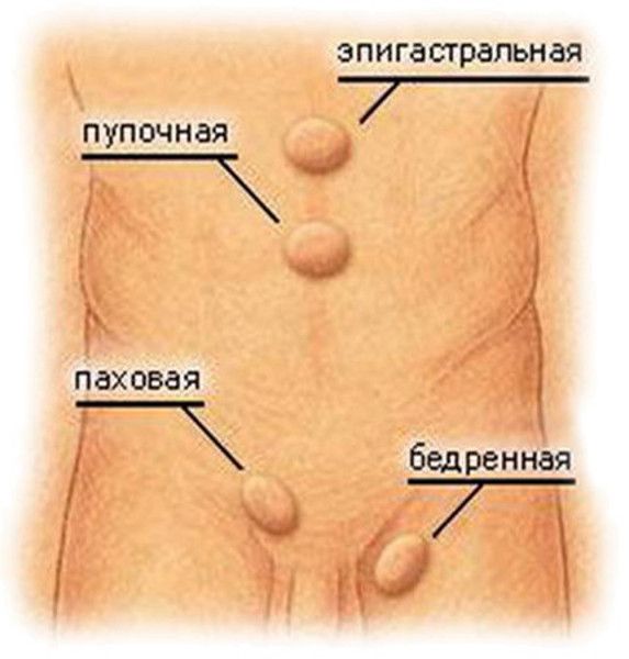 Грыжа внутренних органов: что это такое и кто в зоне риска. Советы хирурга