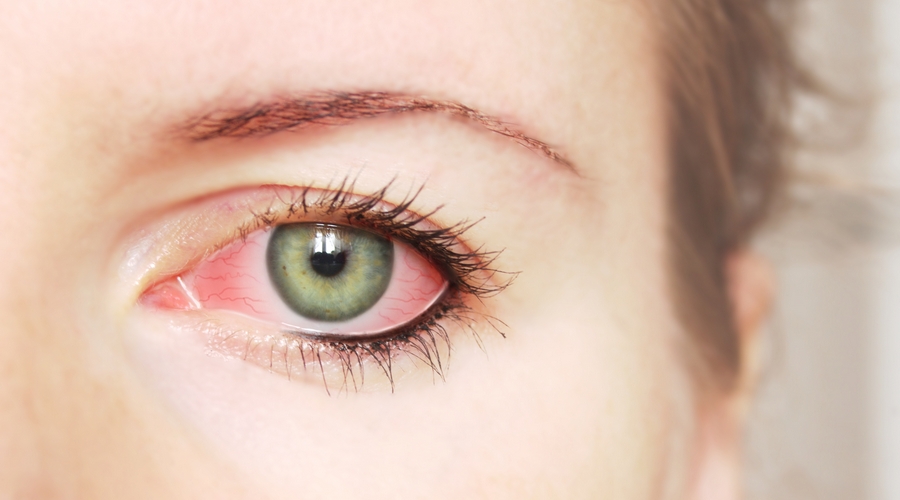 Причины покраснения глаз