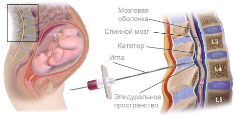 Эпидуральная анестезия беременной куда колят