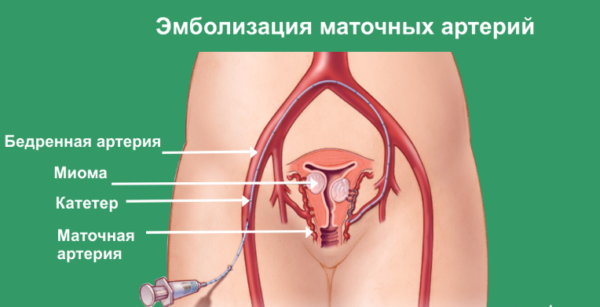 эмболизации маточных артерий (ЭМА)