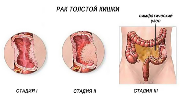 Рак кишечника стадии