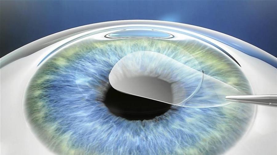 Что такое LASIK операция на глазах