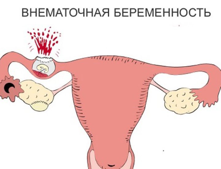 Как распознать внематочную беременность