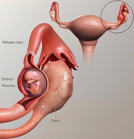 внематочная беременность