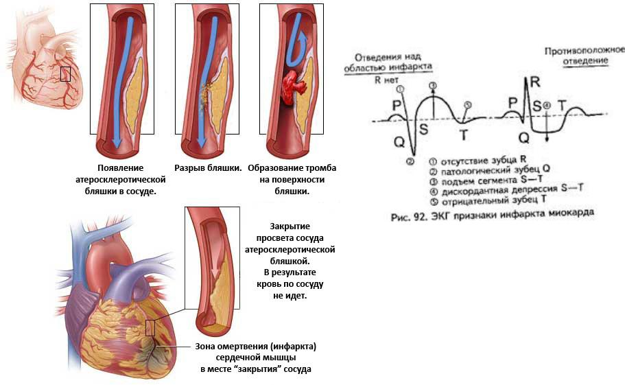 Инфаркт на картинке
