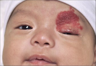 гемангиома на лице ребенка