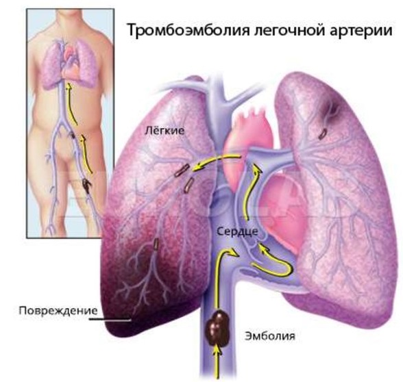 ТРОМБОЭМБОЛИЯ (ЗАКУПОРКА ЛЁГОЧНОЙ АРТЕРИИ ТРОМБОМ)