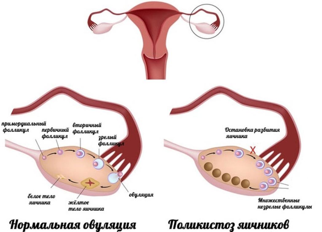 Синдром поликистозных яичников: что это такое, причины и лечение