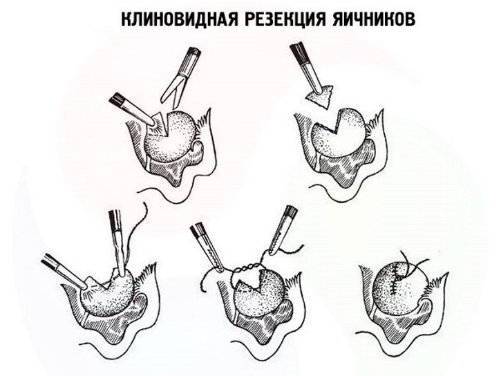 клиновидная резекция яичников