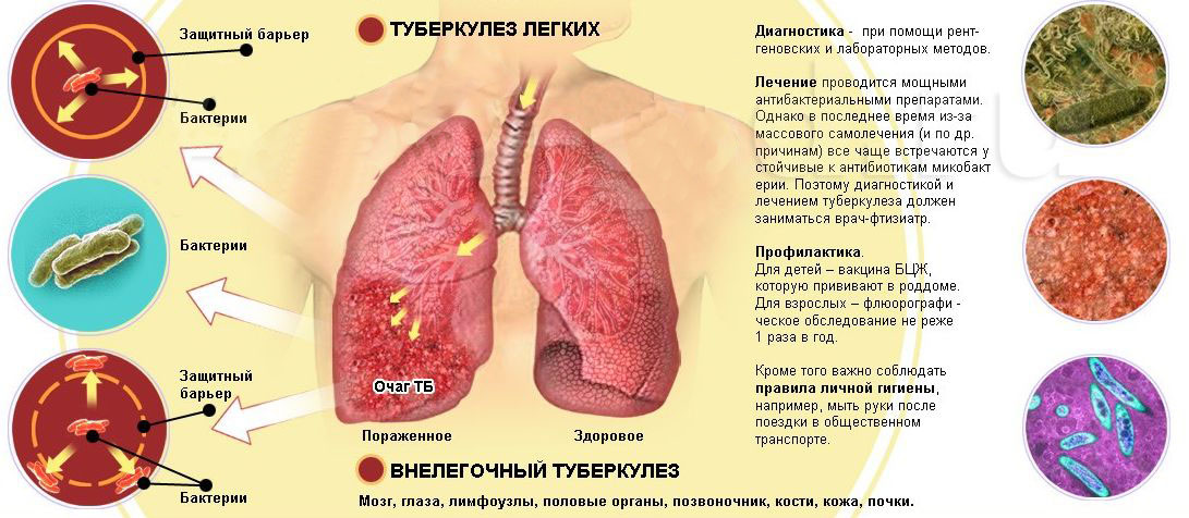 Туберкулез это. Туберкулёз лёгких симптомы причины профилактика. Бактериальные заболевания туберкулез. Профилактика легочного туберкулеза. Открытая форма туберкулёза риск заражения.