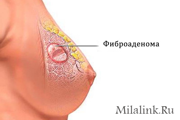 Фиброаденома молочной груди