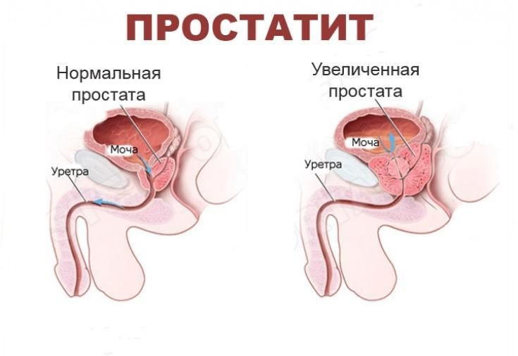 ПРОСТАТИТ