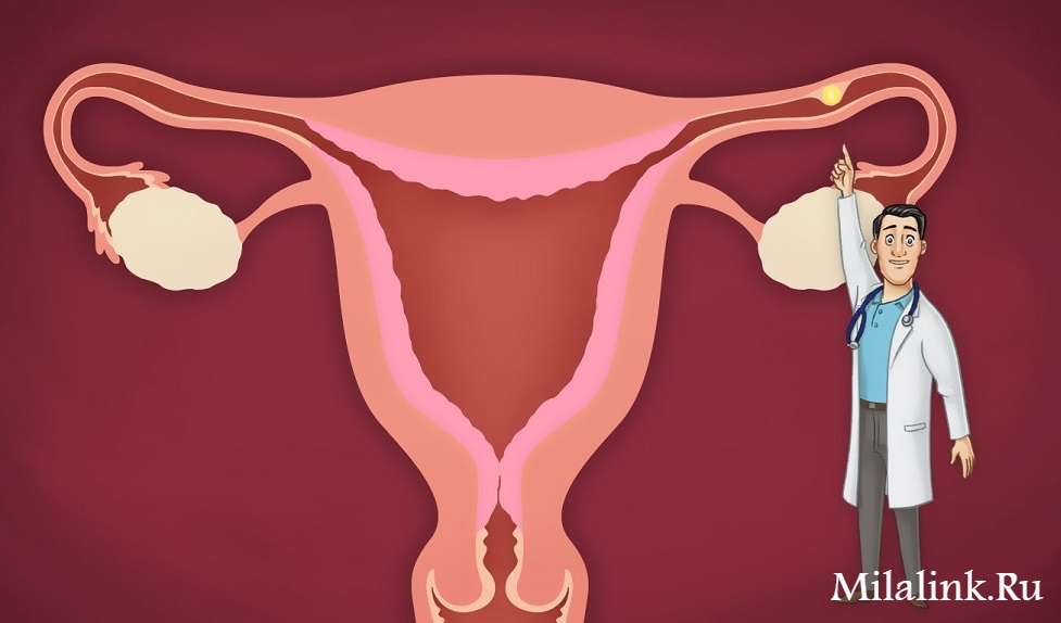 Внематочная беременность: что это, чем опасна, как лечить. Консультация врача-гинеколога