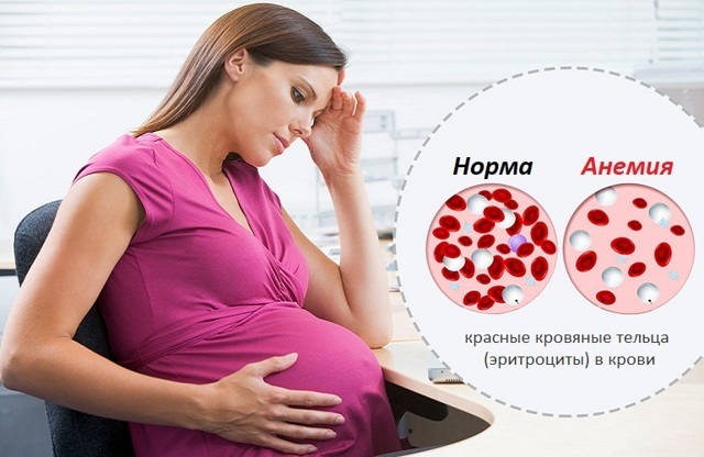 Какие витамины принимать при анемии во время беременности thumbnail