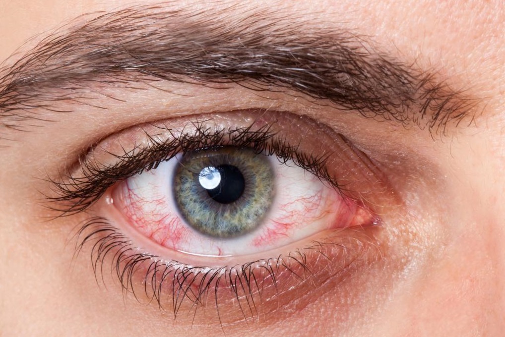 Разрыв капилляров в глазах: причины и профилактика