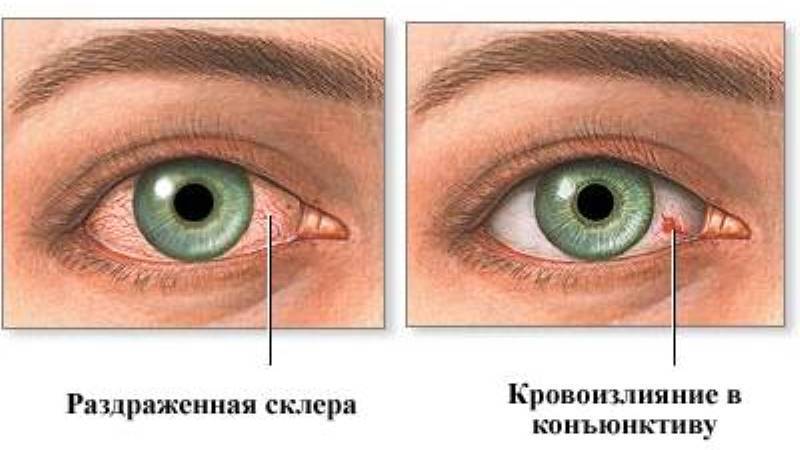 Как лечить красные сосуды в глазах