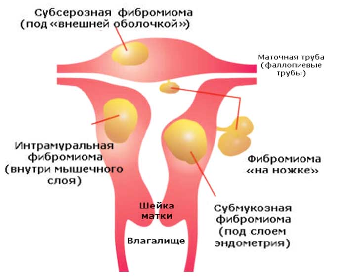 Фиброма матки: причины, симптомы, диагностика и лечение