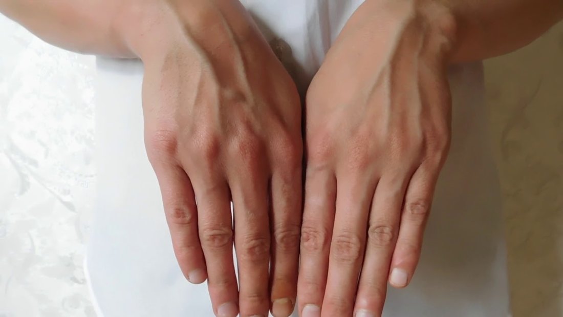 Вздутые вены на руках: причины, лечение