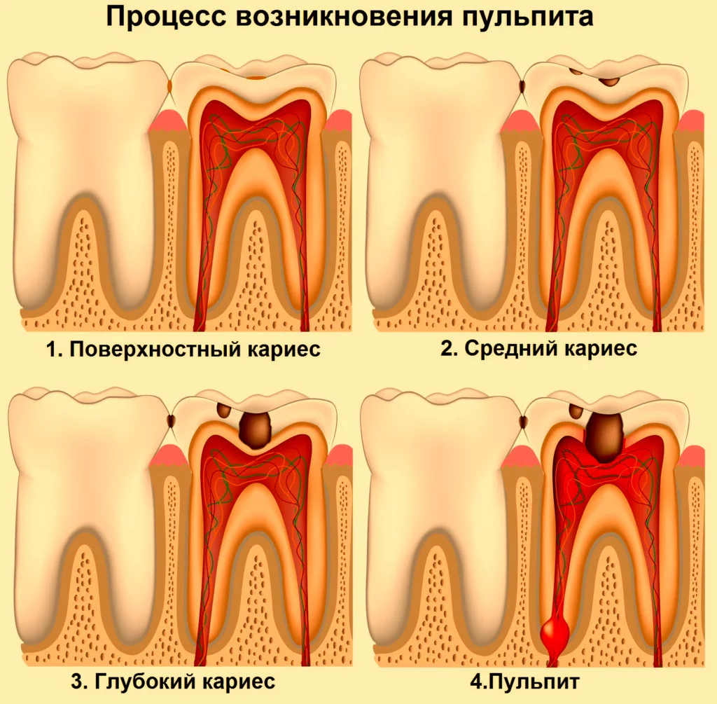 Что такое пульпит зуба