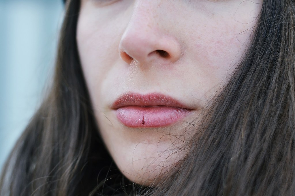 Почему трескаются губы