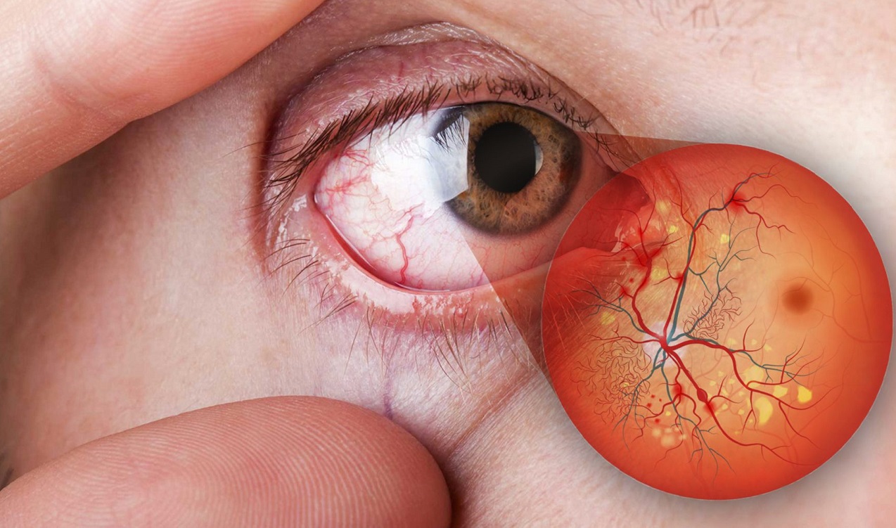 Диабетическая ретинопатия: причины, диагностика и лечение
