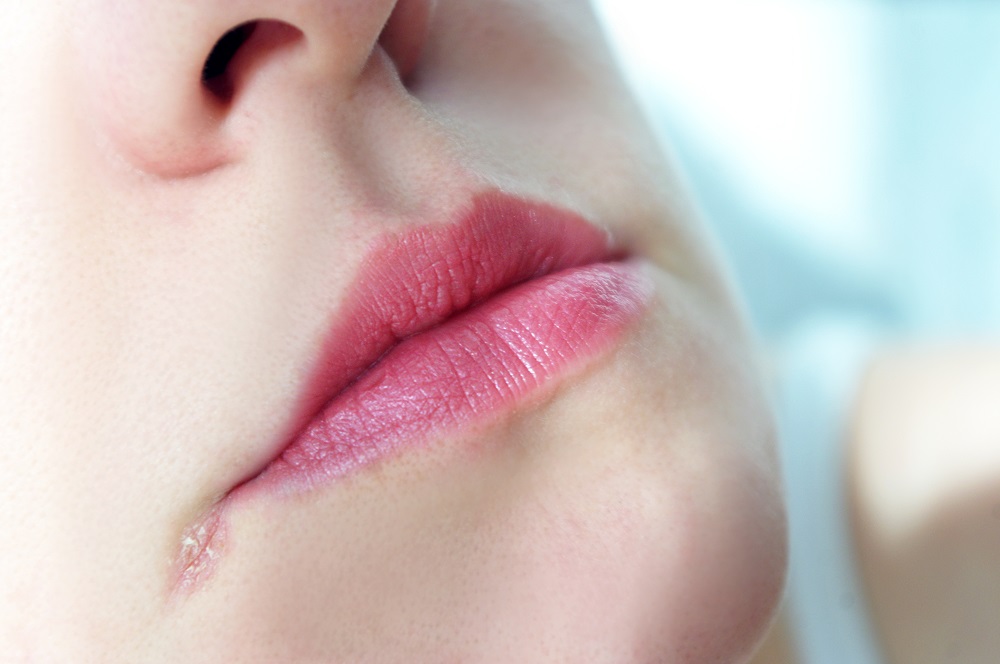 Трещинки в уголках рта: причины появления и способы лечения