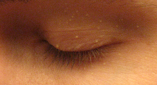 Просянка (милиумы) на лице: причины, симптомы и лечение