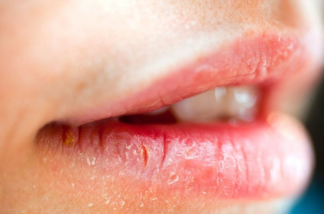 Потрескавшиеся губы: больно и некрасиво