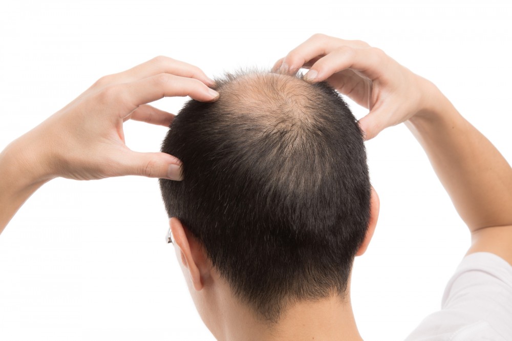 Почему выпадают волосы на голове у мужчин