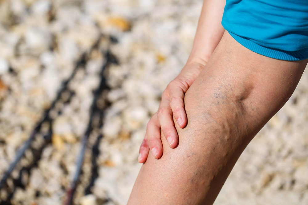 Варикоз на ногах: симптомы, профилактика, как лечить без операции