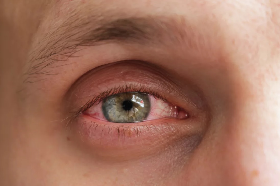 Основные болезни глаз и век